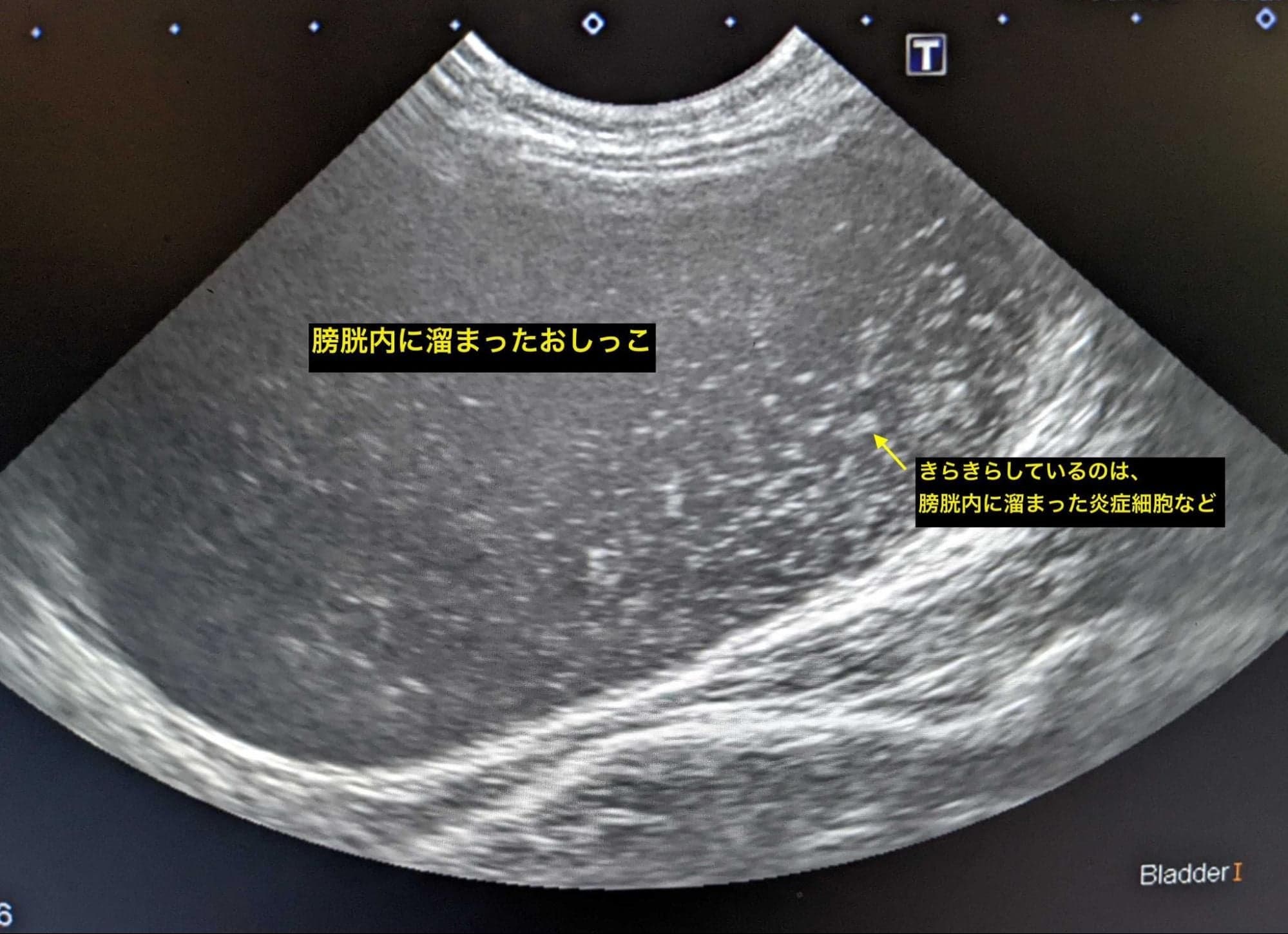 膀胱内に溜まったおしっこのイメージ